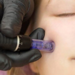 rf microneedling boynton beach