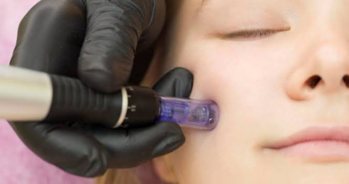 rf microneedling boynton beach