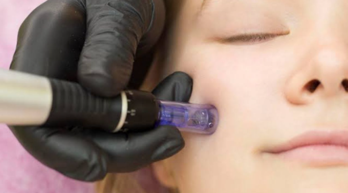 rf microneedling boynton beach